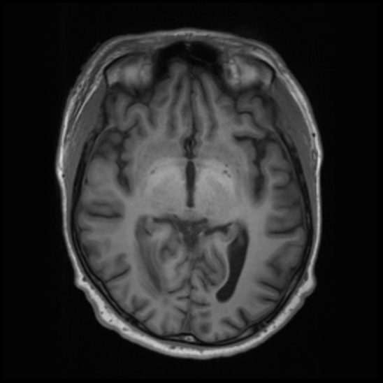File:Cerebral abscess with ventriculitis (Radiopaedia 78965-91878 Axial T1 23).jpg