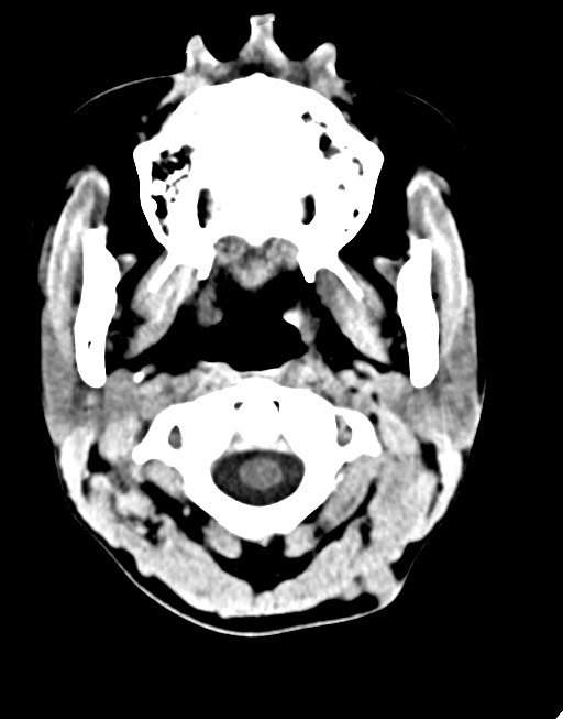Cerebral abscesses (Radiopaedia 70458-80568 Axial non-contrast 6).jpg