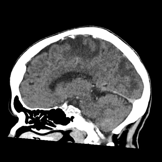 Cerebral amyloid angiopathy-related inflammation (Radiopaedia 74836-85848 C 27).jpg