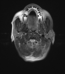File:Cerebral amyloid angiopathy-related inflammation (Radiopaedia 74836-85849 Axial FLAIR 1).jpg