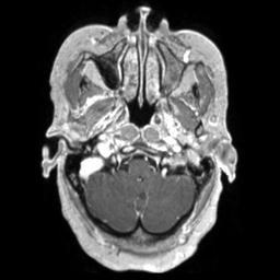 Cerebral amyloid angiopathy (Radiopaedia 29129-29518 Axial T1 C+ 26).jpg