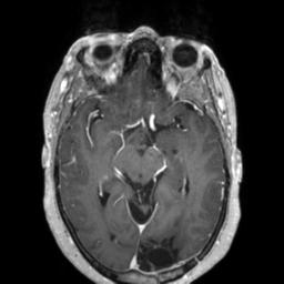 Cerebral amyloid angiopathy (Radiopaedia 29129-29518 Axial T1 C+ 65).jpg