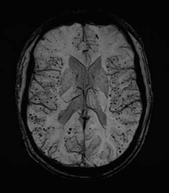 Cerebral amyloid angiopathy (Radiopaedia 46082-50433 Axial SWI MIP 43).png