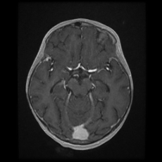 Cerebral and spinal tuberculosis (Radiopaedia 90489-107837 Axial T1 C+ 86).jpg