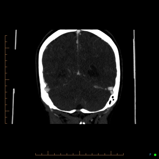 Cerebral arteriovenous malformation (AVM) (Radiopaedia 78162-90706 Coronal CTA 30).jpg