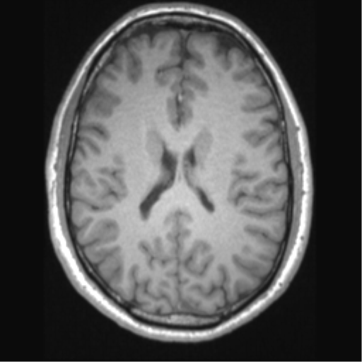 Cerebral arteriovenous malformation (Radiopaedia 39259-41506 Axial T1 47).png