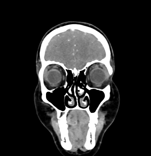 Cerebral arteriovenous malformation (Radiopaedia 73830-84645 C 17).jpg