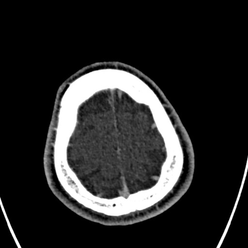 Cerebral arteriovenous malformation (Radiopaedia 78188-90746 Axial C+ delayed 153).jpg