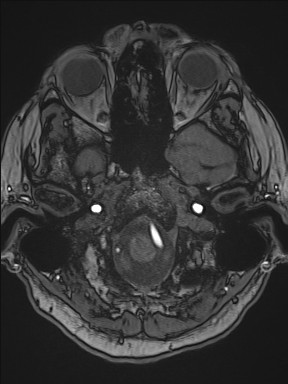 Cerebral arteriovenous malformation (Radiopaedia 84015-99245 Axial TOF 60).jpg