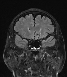 File:Cerebral arteriovenous malformation (Radiopaedia 84015-99245 Coronal FLAIR 12).jpg