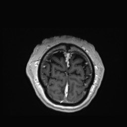 Cerebral arteriovenous malformation (Radiopaedia 84015-99245 Coronal T1 C+ 159).jpg