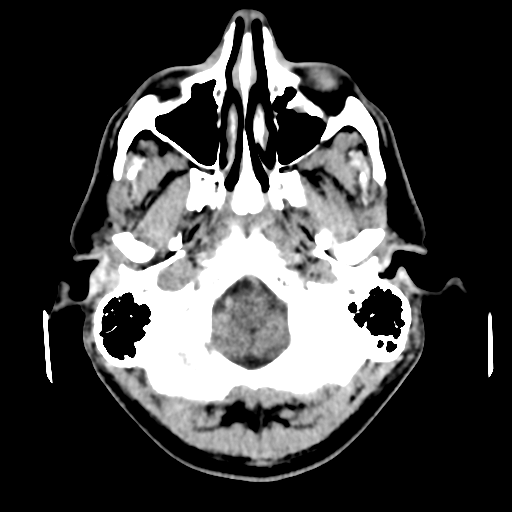 Cerebral arteriovenous malformation (Spetzler-Martin grade 2) (Radiopaedia 41262-44076 Axial non-contrast 9).png