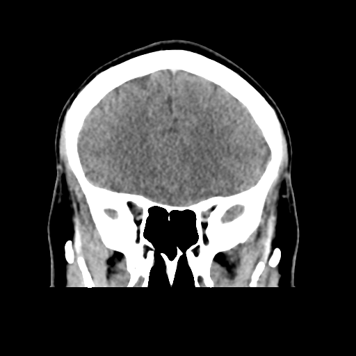 File:Cerebral arteriovenous malformation (Spetzler-Martin grade 2) (Radiopaedia 41262-44076 Coronal non-contrast 18).png