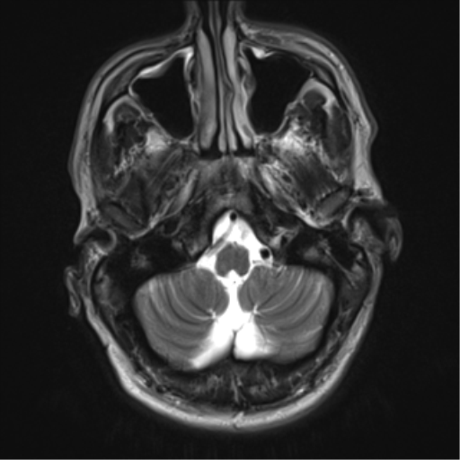 File:Cerebral arteriovenous malformation - huge (Radiopaedia 35734-37272 Axial T2 3).png