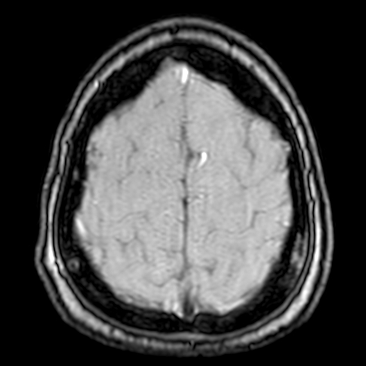 Cerebral arteriovenous malformation at posterior body of corpus callosum (Radiopaedia 74111-84925 Axial MRA 195).jpg