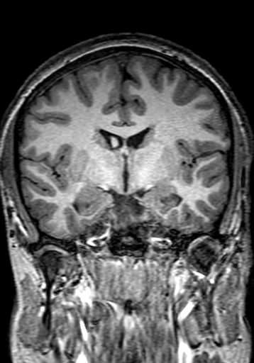 Cerebral arteriovenous malformation at posterior body of corpus callosum (Radiopaedia 74111-84925 Coronal T1 150).jpg