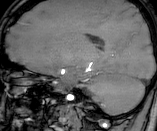 Cerebral arteriovenous malformation at posterior body of corpus callosum (Radiopaedia 74111-84925 J 249).jpg