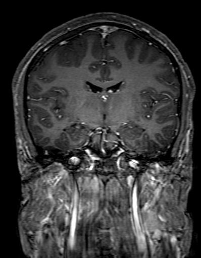 Cerebral arteriovenous malformation at posterior body of corpus callosum (Radiopaedia 74111-84925 K 180).jpg