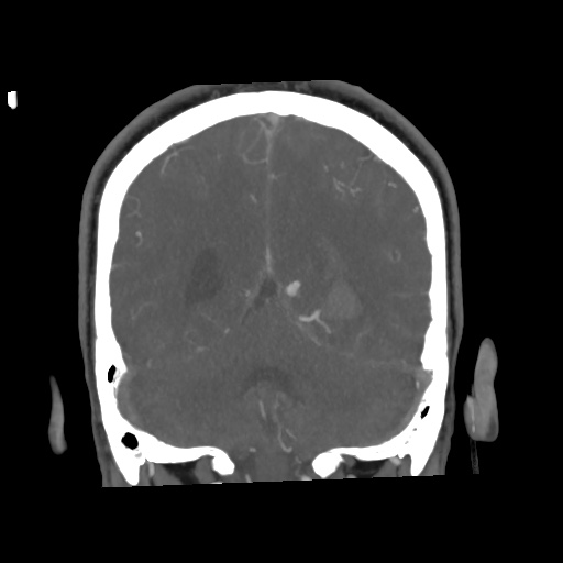 Cerebral arteriovenous malformation with lobar hemorrhage (Radiopaedia 35598-57216 C 67).jpg