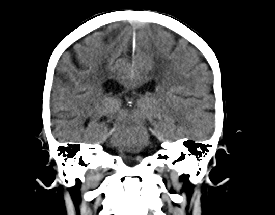 Cerebral arteriovenous malformation with lobar hemorrhage (Radiopaedia 44725-48510 Coronal non-contrast 30).png