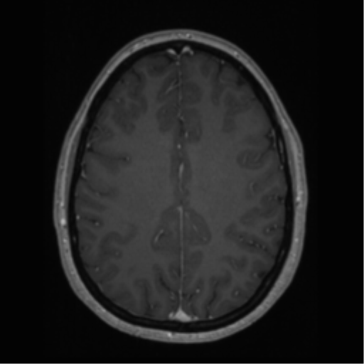 Cerebral cavernoma and development venous anomaly (Radiopaedia 37603-39482 Axial T1 C+ 51).png