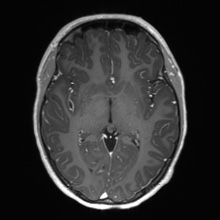 Cerebral cavernous venous malformation (Radiopaedia 70008-80021 Axial T1 C+ 34).jpg