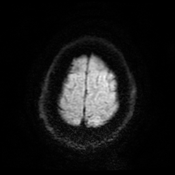 Cerebral cavernous venous malformation (Zabramski type II) (Radiopaedia 85511-101198 Axial DWI 28).jpg