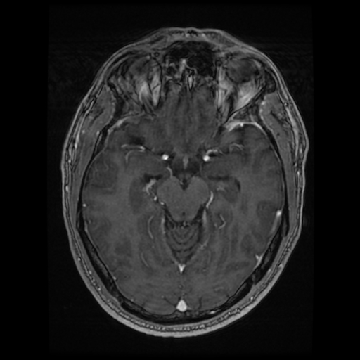 Cerebral cavernous venous malformation (Zabramski type II) (Radiopaedia 85511-101198 Axial T1 C+ fat sat 52).jpg