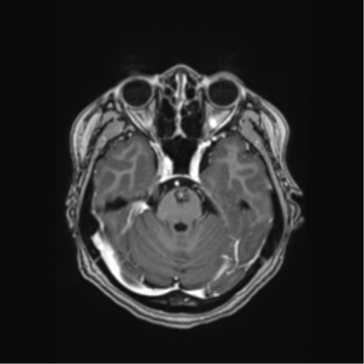 Cerebral cavernous venous malformations (Radiopaedia 48117-52946 Axial T1 C+ 15).png