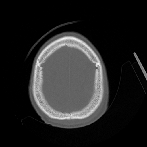 Cerebral contusions, subarachnoid hemorrhage and subdural hygromas (Radiopaedia 55399-61827 Axial bone window 45).png