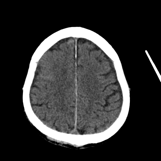 File:Cerebral contusions, subarachnoid hemorrhage and subdural hygromas (Radiopaedia 55399-61827 Axial non-contrast 24).png