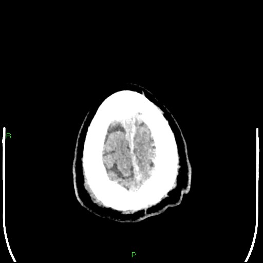 Cerebral contusions (Radiopaedia 33868-35039 Axial non-contrast 207).jpg