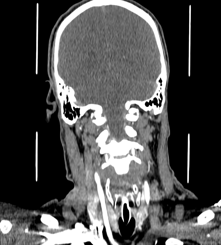 Cerebral edema in an overdose patient (Radiopaedia 72005-82539 B 102).jpg