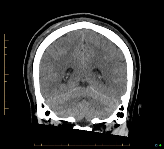 Cerebral fat embolism (Radiopaedia 85521-101224 Coronal non-contrast 44).jpg