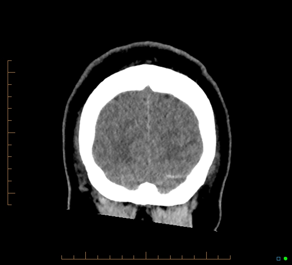 Cerebral fat embolism (Radiopaedia 85521-101224 Coronal non-contrast 56).jpg