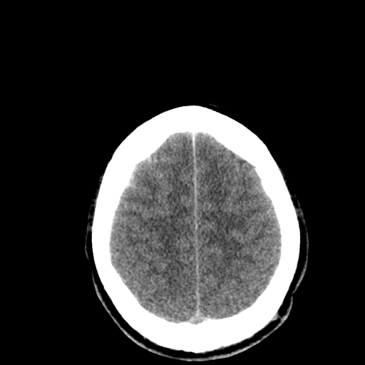 File:Cerebral hemorrhagic contusions- temporal evolution (Radiopaedia 40224-42753 Axial non-contrast 27).png