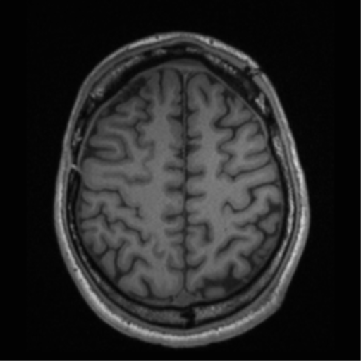 Cerebral hemorrhagic contusions- temporal evolution (Radiopaedia 40224-42757 Axial T1 60).png