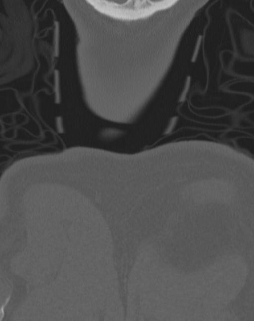 Cerebral hemorrhagic contusions and cervical spine fractures (Radiopaedia 32865-33841 Coronal bone window 90).jpg