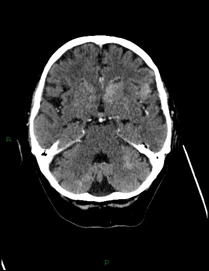 Cerebral metastases - ependymal and parenchymal (Radiopaedia 79877-93131 Axial C+ delayed 27).jpg