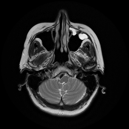File:Cerebral metastases - melanoma (Radiopaedia 80972-94522 Axial T2 6).jpg