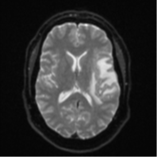Cerebral metastases mimicking multifocal glioblastoma (Radiopaedia 50843-56353 Axial DWI 15).png