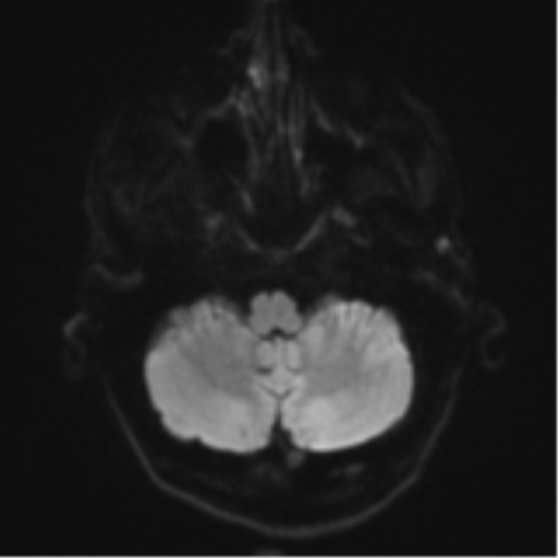 Cerebral metastasis - melanoma (Radiopaedia 54718-60954 Axial DWI 37).png