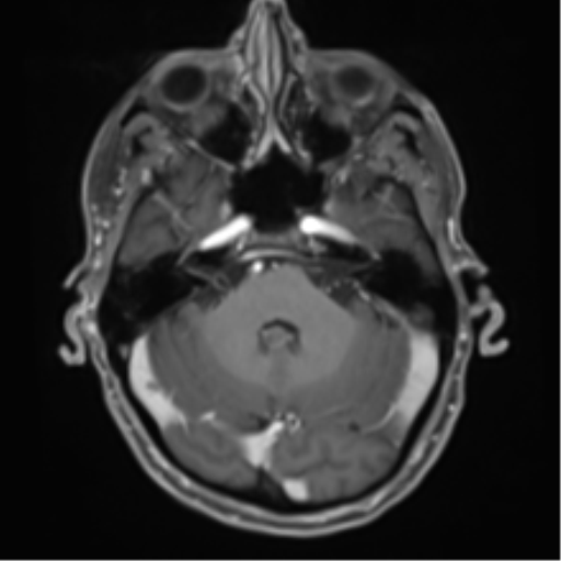 Cerebral metastasis - melanoma (Radiopaedia 54718-60954 Axial T1 C+ fat sat 15).png