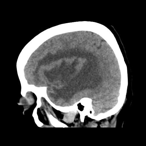 Cerebral metastasis to basal ganglia (Radiopaedia 81568-95412 E 18).png