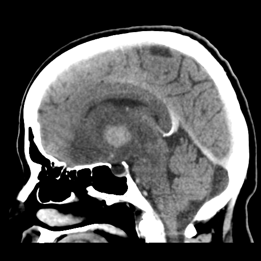 Cerebral metastasis to basal ganglia (Radiopaedia 81568-95412 Sagittal C+ delayed 29).png