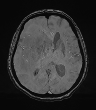 Cerebral metastasis to basal ganglia (Radiopaedia 81568-95413 Axial SWI magnitude 46).png