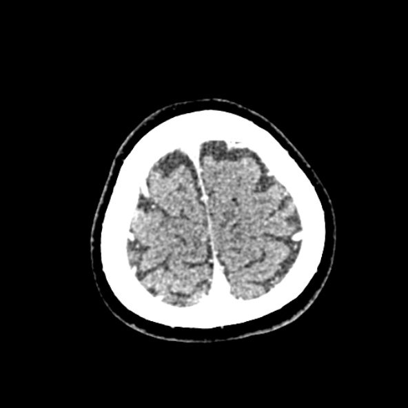Cerebral ring enhancing lesions - cerebral metastases (Radiopaedia 44922-48818 B 255).jpg