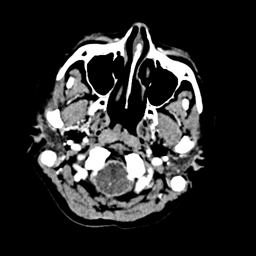 Cerebral tuberculosis with dural sinus invasion (Radiopaedia 60353-68019 Axial C+ delayed 4).jpg