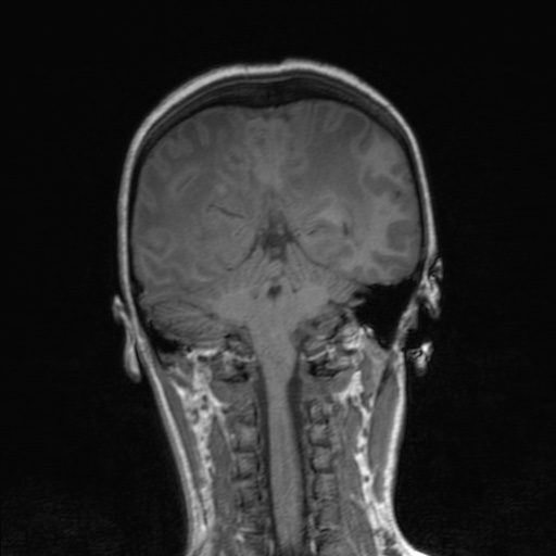 Cerebral tuberculosis with dural sinus invasion (Radiopaedia 60353-68090 Coronal T1 127).jpg