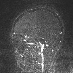 Cerebral tuberculosis with dural sinus invasion (Radiopaedia 60353-68090 Sagittal MRV 38).jpg